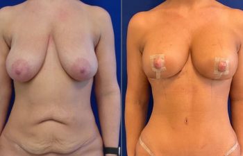 patient before and after breast reduction