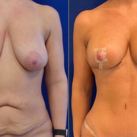 patient before and after breast reduction