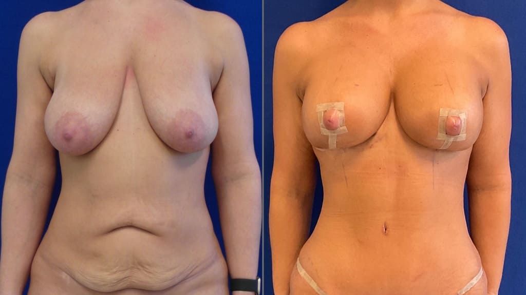 36 year-old before and after breast lift with an augmentation