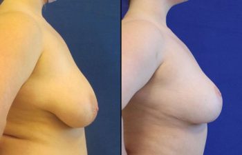 patient before and after breast reduction