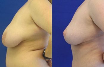 patient before and after breast reduction