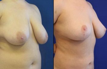 patient before and after breast reduction