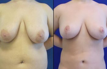 patient before and after breast reduction