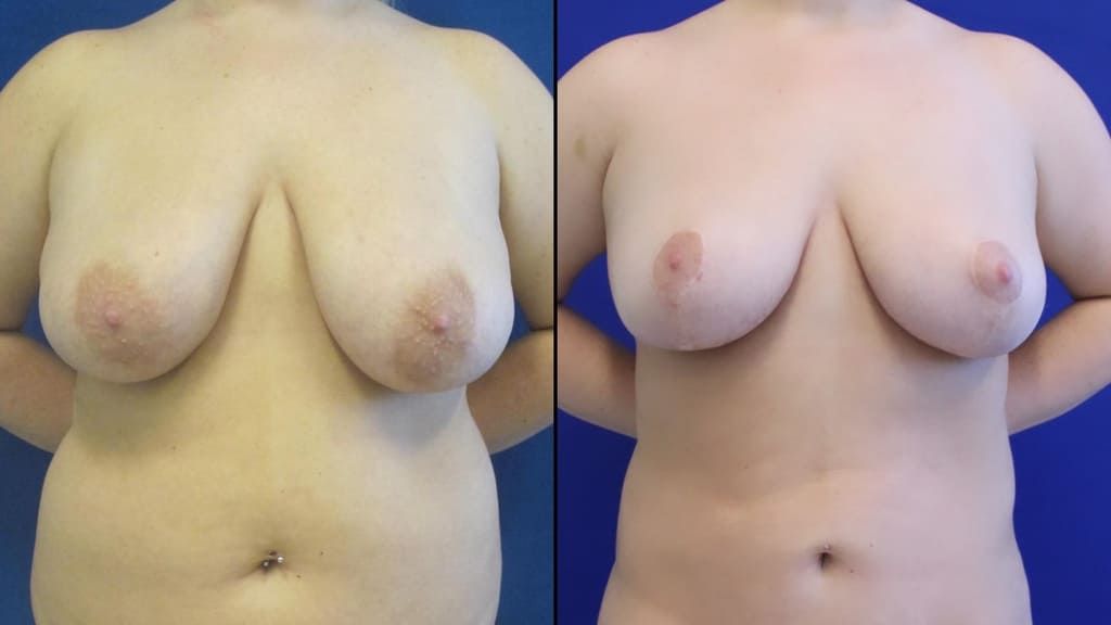 patient before and after breast reduction