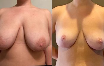patient before and after breast reduction