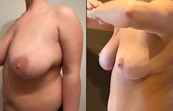 patient before and after breast reduction