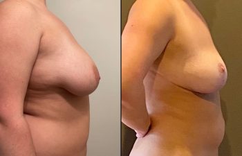 patient before and after breast reduction