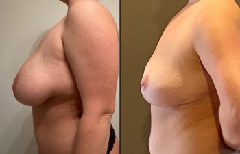patient before and after breast reduction