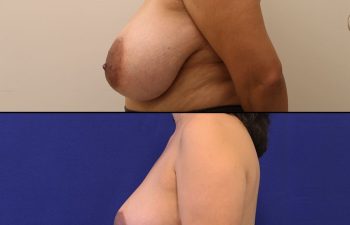 patient before and after breast reduction