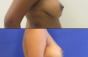 patient before and after breast reduction