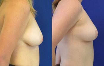 patient before and after breast reduction