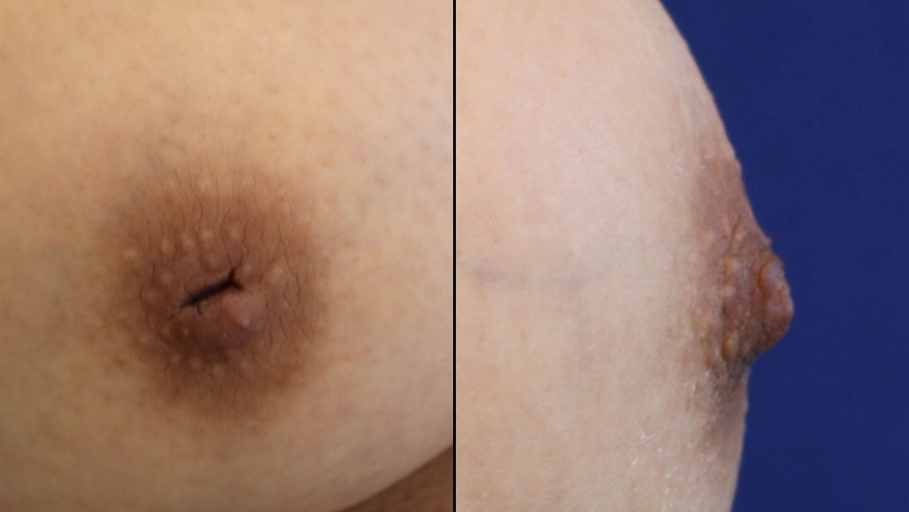 Photo of before and after nipple surgery - side