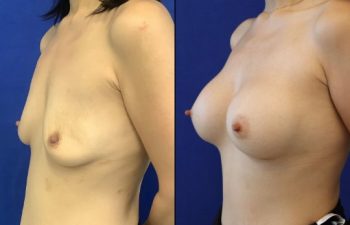 30 year-old patient before and after breast augmentation