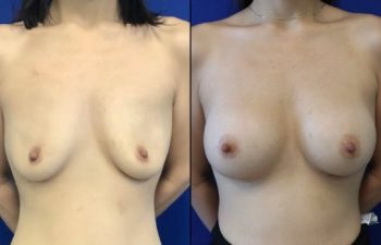 30 year-old patient before and after breast augmentation