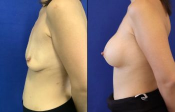 30 year-old patient before and after breast augmentation