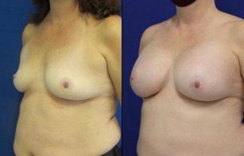 50 year-old patient before and after breast augmentation