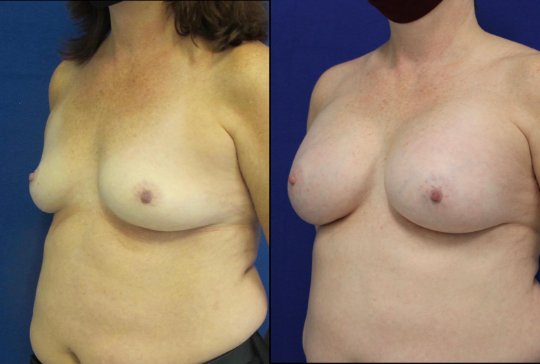 50 year-old patient before and after breast augmentation