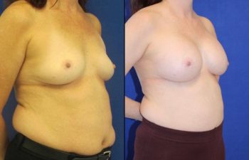 50 year-old patient before and after breast augmentation