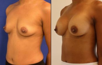 37 year-old patient before and after breast augmentation