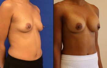 37 year-old patient before and after breast augmentation