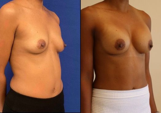 37 year-old patient before and after breast augmentation