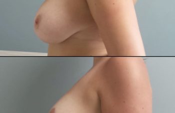 patient before and after breast reduction