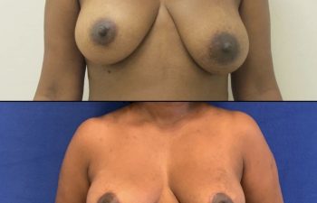 patient before and after breast reduction