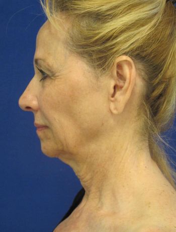 patient before procedure