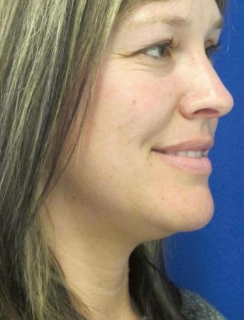 patient before procedure
