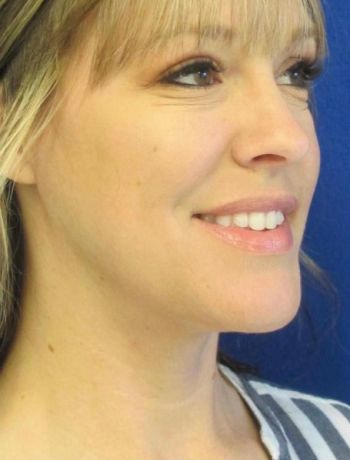 patient after procedure