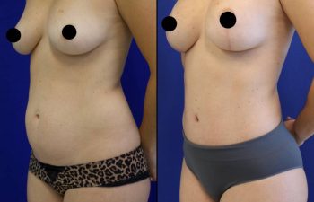 patient before and after breast lift with augmentation