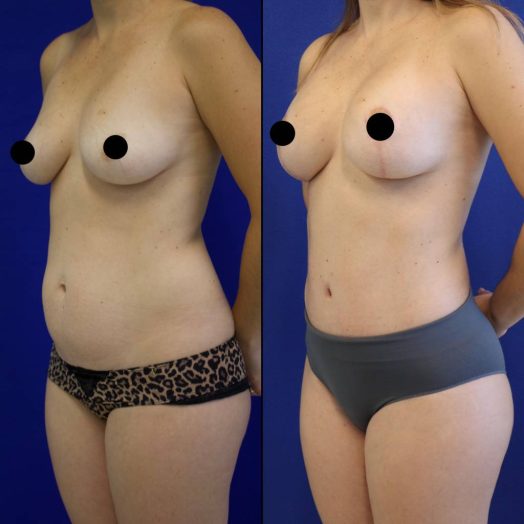 patient before and after breast lift with augmentation