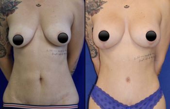 patient before and after breast lift with augmentation