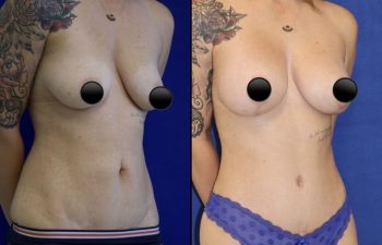 patient before and after breast lift with augmentation