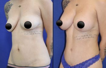 patient before and after breast lift with augmentation