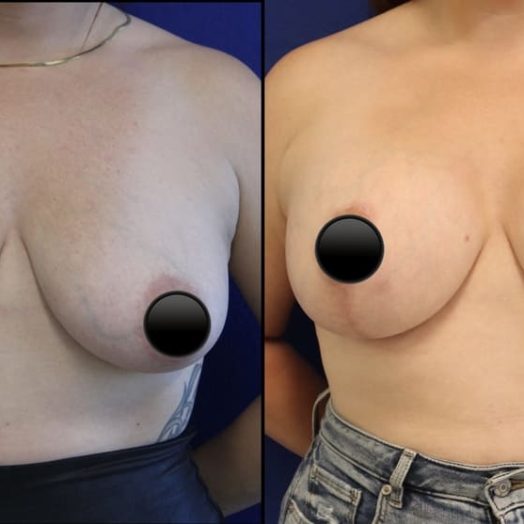 patient before and after breast lift with augmentation