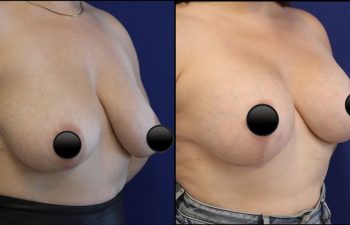 patient before and after breast lift with augmentation