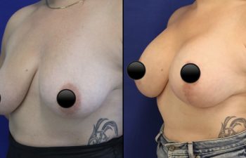 patient before and after breast lift with augmentation