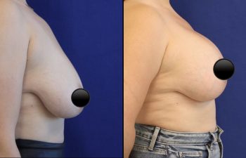 patient before and after breast lift with augmentation