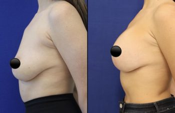 patient before and after breast lift with augmentation