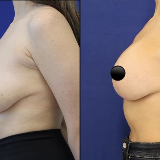 patient before and after breast lift with augmentation