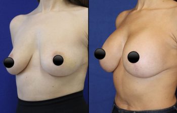 patient before and after breast lift with augmentation