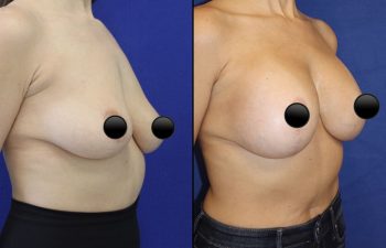 patient before and after breast lift with augmentation