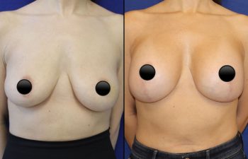 patient before and after breast lift with augmentation