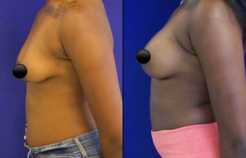 patient before and after breast lift with augmentation