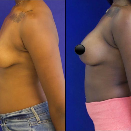patient before and after breast lift with augmentation