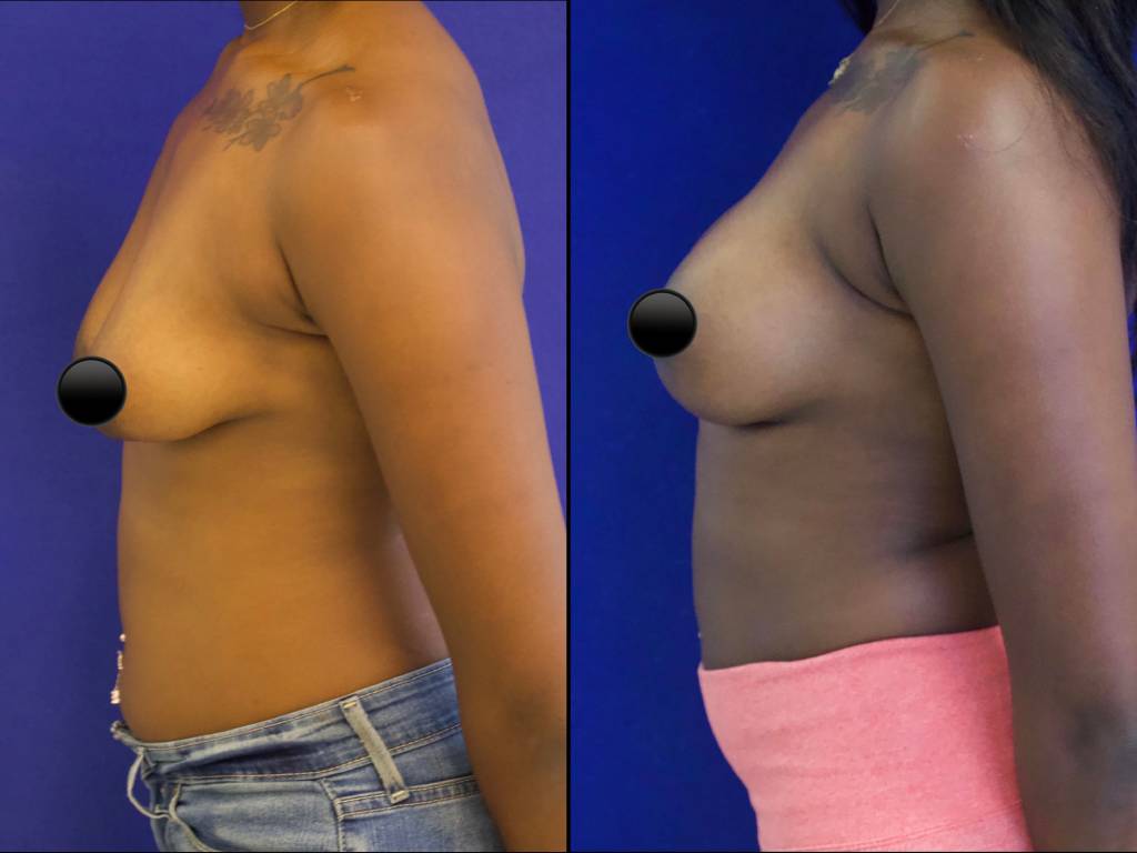 patient before and after breast lift with augmentation