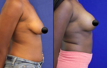 patient before and after breast lift with augmentation