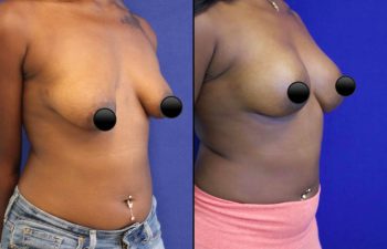 patient before and after breast lift with augmentation