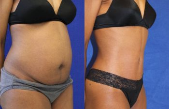 before/after